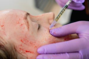 PRP Facial