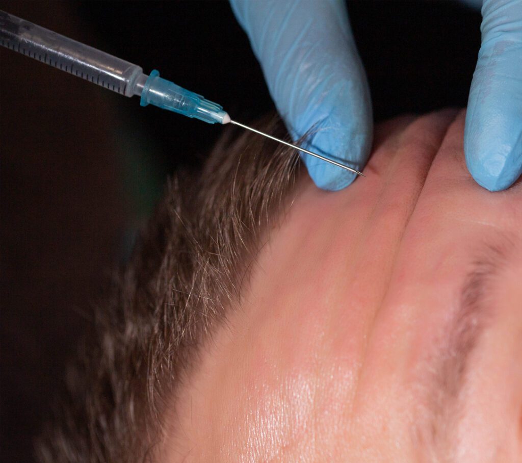 Doctor cosmetologist makes anti-aging injections into the forehead of a man against wrinkles