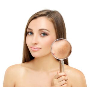 Freckles,dark spots,hyperpigmentation(melasma or chloasma)