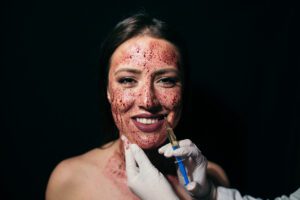 Woman having a vampire facial treatment