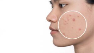 Close of a young woman with acne skin in zoom circle. Face of Asian females with circles shows problem skin before and after acne treatment. Beautician concept.
