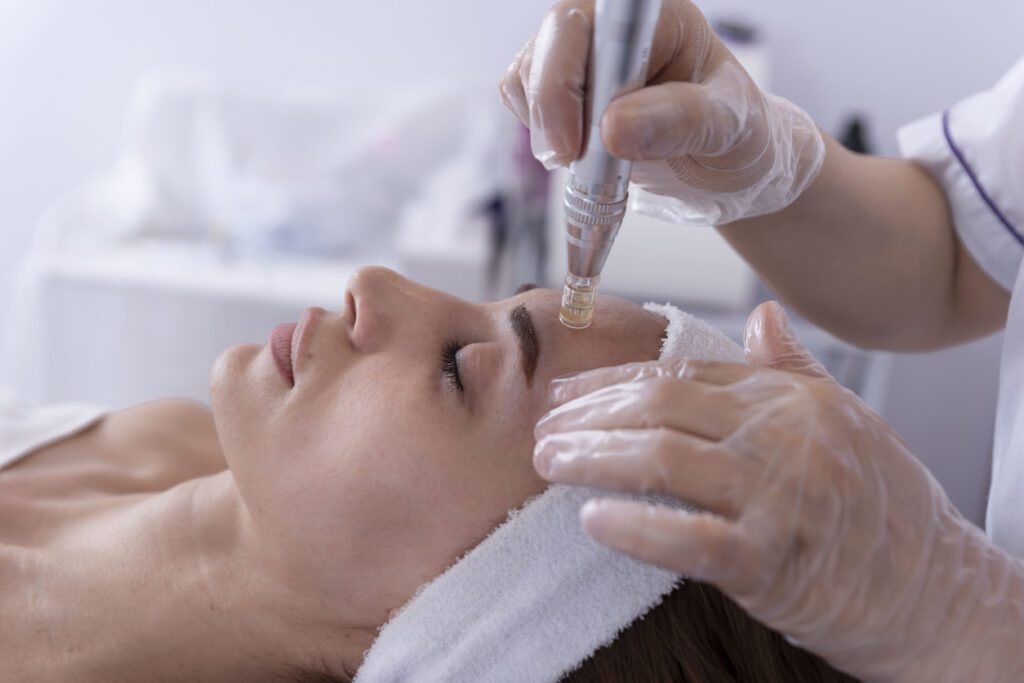 Women Getting RF Microneedling Treatment