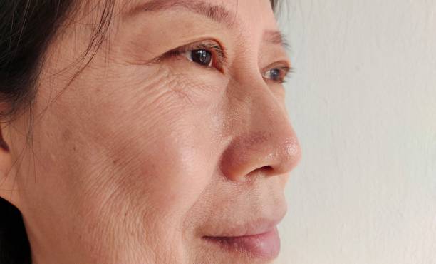 Portrait showing the flabbiness adipose hanging skin under the eyes, ptosis and flabby skin beside the eyelid, smile lines beside the mouth, freckles and blemish on the face of the woman, health care and beauty concept.