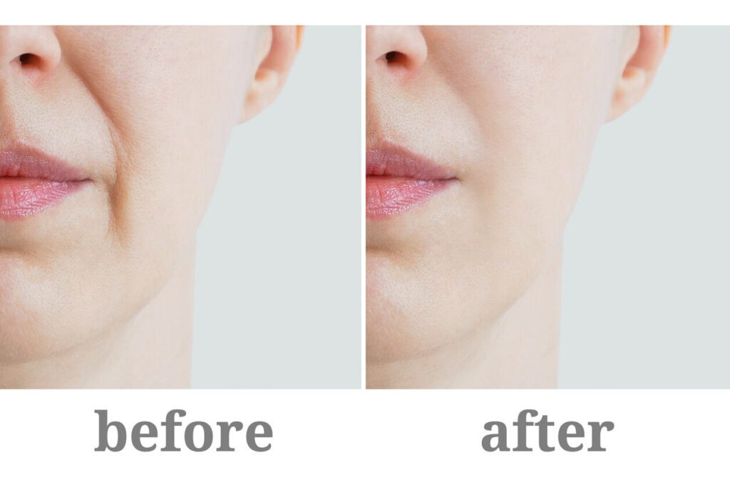 Close-up of the nasolabial fold on a Caucasian woman's face, before and after Smile Line Fillers treatment.