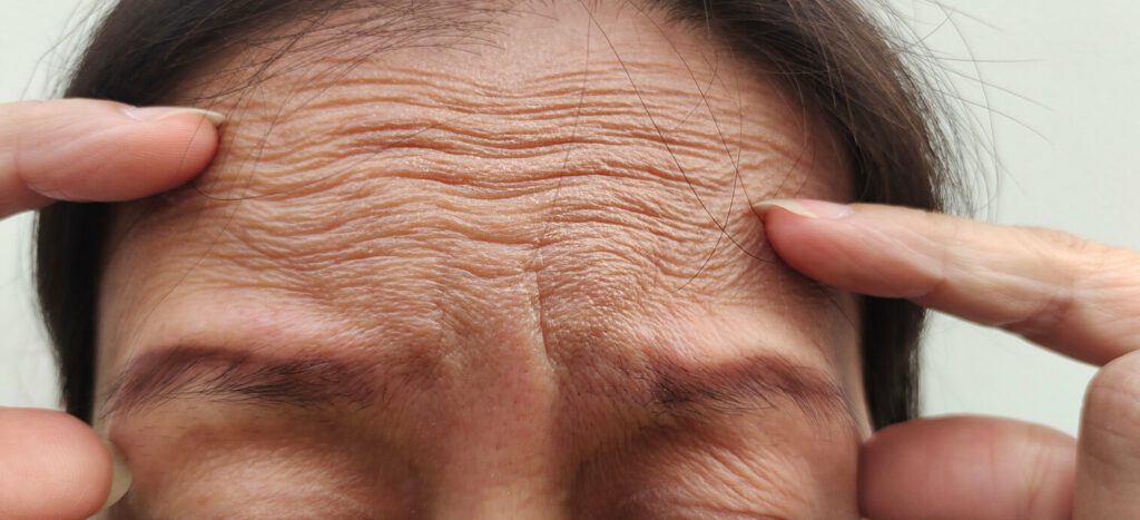 Forehead wrinkles and loose skin appear on the forehead lines of a person.