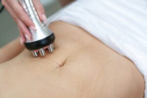 Radiofrequency Microneedling to reduce stretch marks on the skin after childbirth and weight loss.