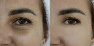 A woman before and after treatment for PRF under-eye injections.